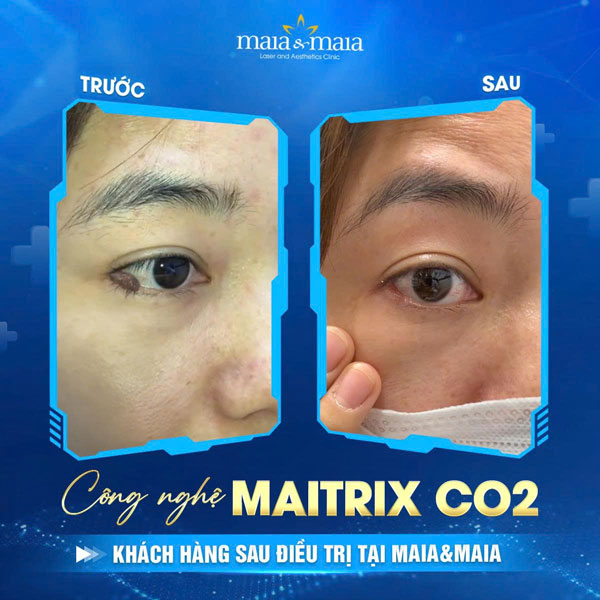 khách hàng xóa nốt ruồi thành công