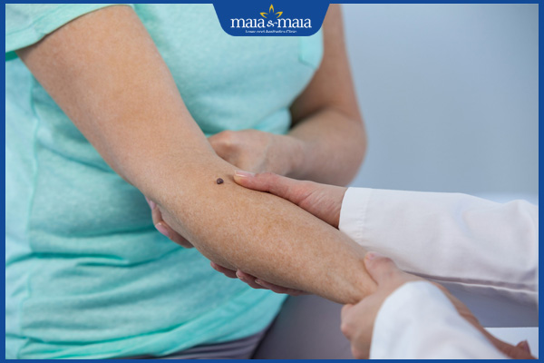 khám bác sĩ nốt ruồi