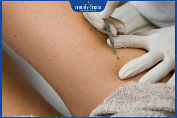 Nốt ruồi ở đùi ẩn chứa ý nghĩa gì? Gợi ý địa chỉ tẩy bỏ nốt ruồi uy tín hiện nay 4 nốt ruồi ở đùi