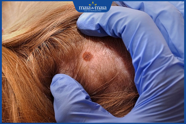 kiểm tra nốt ruồi trên đầu