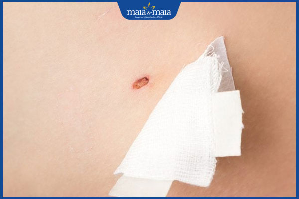 làn da sau tẩy nốt ruồi