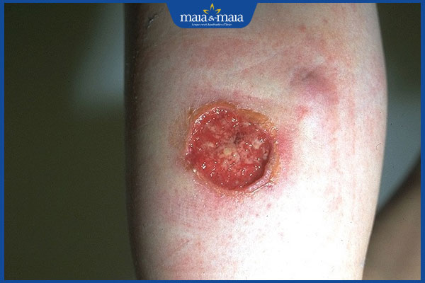 loét da ở chân