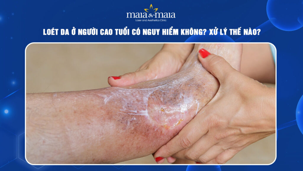 loét da ở người cao tuổi