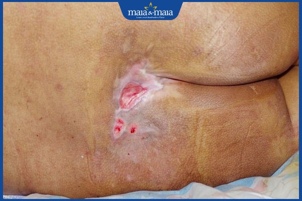 loét do tỳ đè sâu