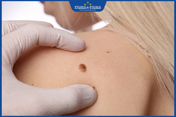 Ý nghĩa các vị trí nốt ruồi ở vai trong nhân tướng học 2 mọc nốt ruồi ở vai