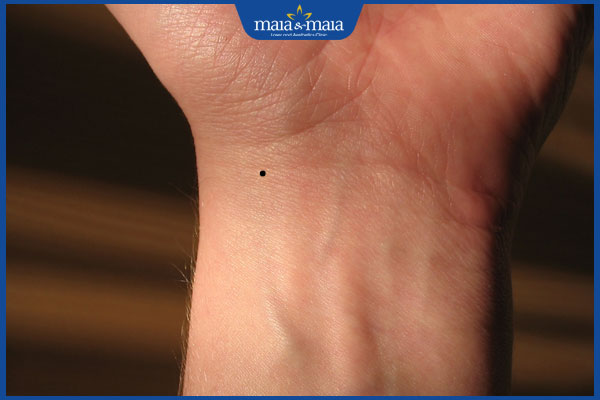 mọc nốt ruồi ở cổ tay