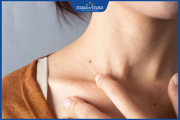 mọc nốt ruồi ở cổ