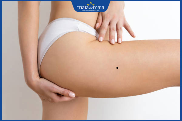 Nốt ruồi ở đùi ẩn chứa ý nghĩa gì? Gợi ý địa chỉ tẩy bỏ nốt ruồi uy tín hiện nay 2 mọc nốt ruồi ở đùi