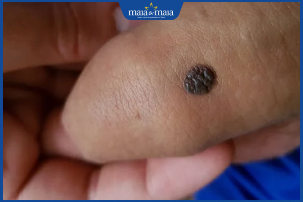 mọc nốt ruồi ở dương vật