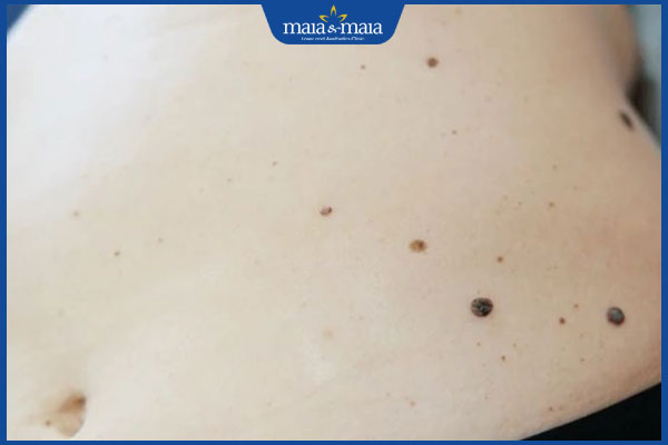 mọc nốt ruồi ở hông