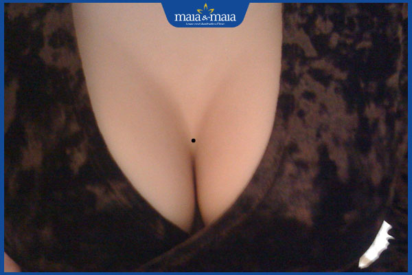 mọc nốt ruồi ở khe ngực