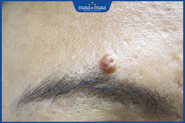 mọc nốt ruồi ở lông mày