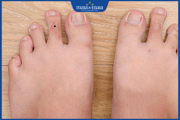 nốt ruồi ở ngón chân trỏ