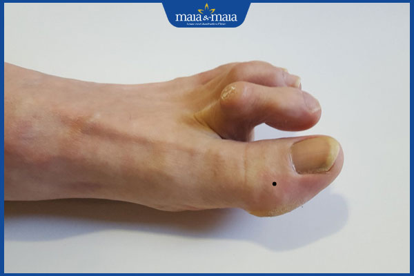 mọc nốt ruồi ở ngón chân