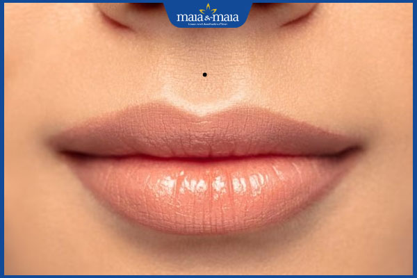 mọc nốt ruồi ở nhân trung