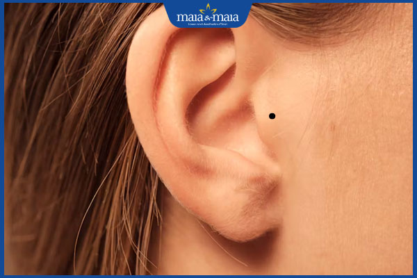 mọc nốt ruồi ở phong đương