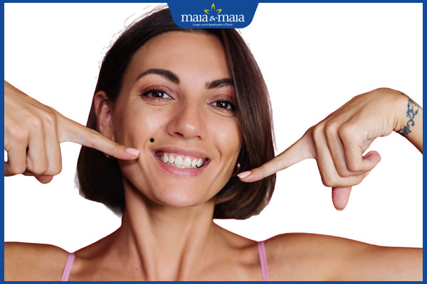 mọc nốt ruồi ở rãnh cười