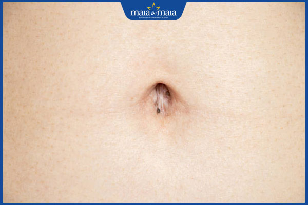 mọc nốt ruồi ở rốn