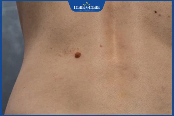 mọc nốt ruồi ở sườn