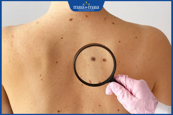 mọc nốt ruồi sau lưng