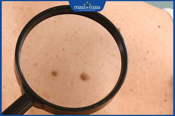 mọc nốt ruồi song song