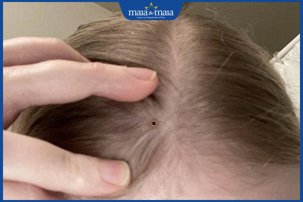 mọc nốt ruồi trên đỉnh đầu