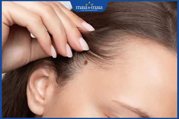 mọc nốt ruồi trong tóc