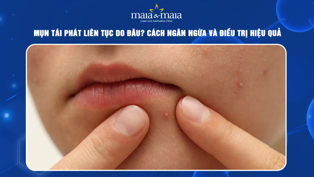 Mụn tái phát liên tục do đâu? Cách ngăn ngừa và điều trị 1 mụn tái phát