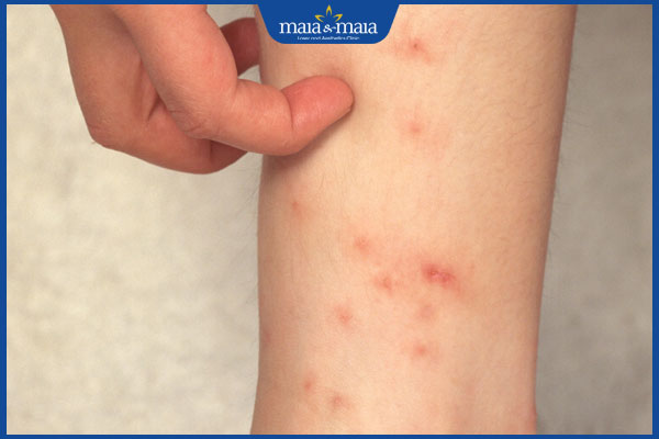 ngứa ghẻ ở chân