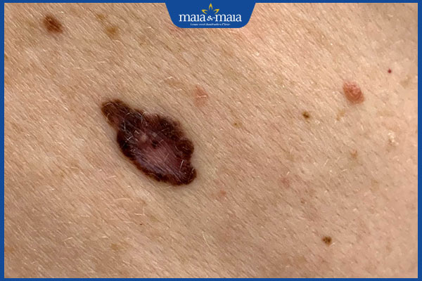 Cách nhận biết nốt ruồi ác tính hay nốt ruồi bình thường 2 nhận biết nốt ruồi ác tính