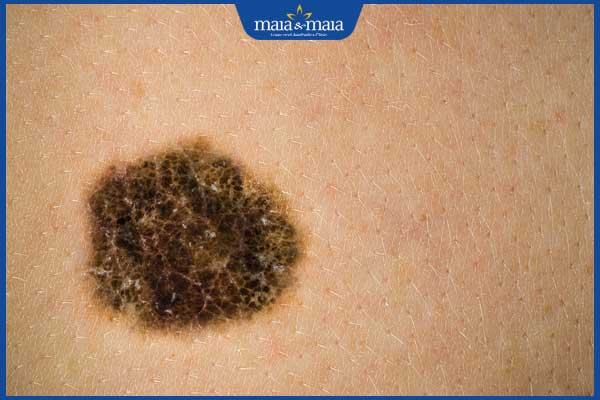 nhận biết nốt ruồi ung thư hắc tố