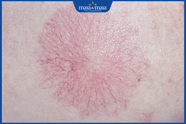 Nốt ruồi mạng nhện là tình trạng gì? Có nguy hiểm không? 2 nhận biết u mạch nhện