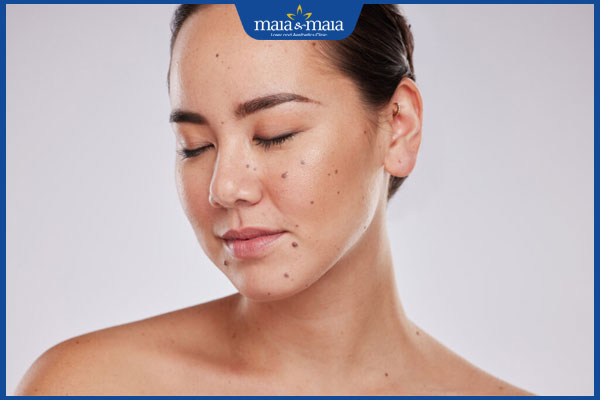 nhiều nốt ruồi trên mặt