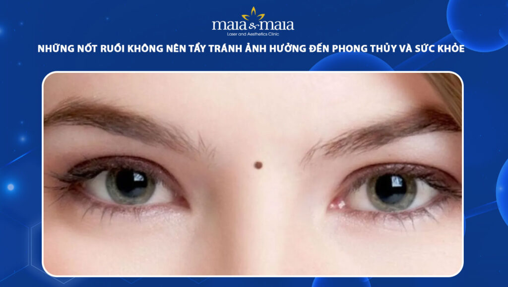 những nốt ruồi không nên tẩy