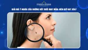 Những nốt ruồi may mắn