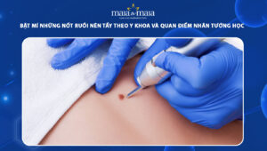 những nốt ruồi nên tẩy