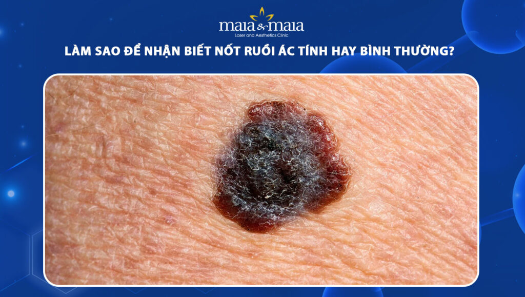 Cách nhận biết nốt ruồi ác tính hay nốt ruồi bình thường 1 nốt ruồi ác tính
