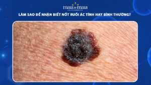 nốt ruồi ác tính