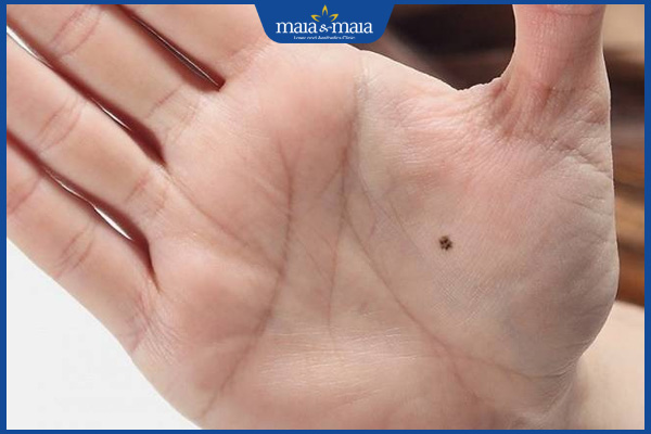 nốt ruồi bàn tay