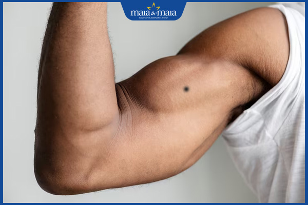 nốt ruồi bắp tay nam