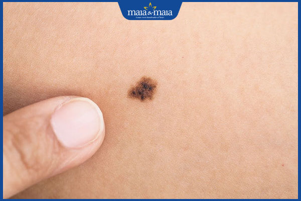 nốt ruồi bất thường