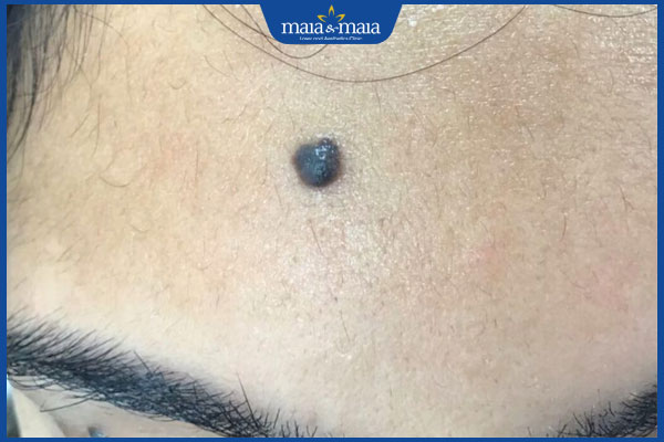 nốt ruồi bên phải trán