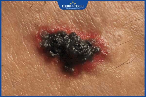 nốt ruồi bị ung thư hắc tố