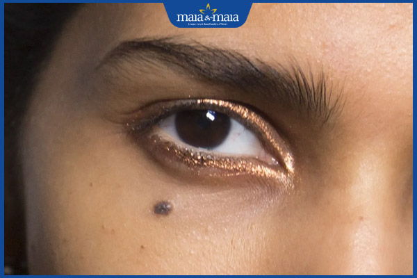 8 nốt ruồi xấu trên mặt phụ nữ và cách loại bỏ hiệu quả 3 nốt ruồi bọng mắt