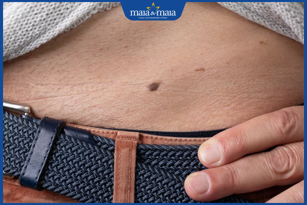 nốt ruồi bụng dưới