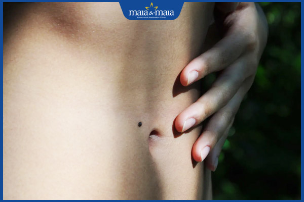 nốt ruồi bụng gần rốn
