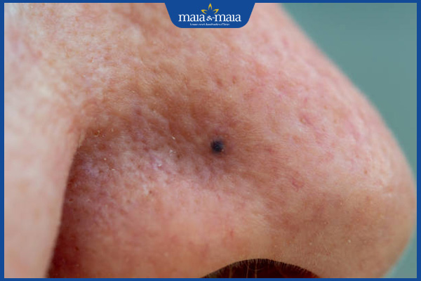 nốt ruồi cánh mũi