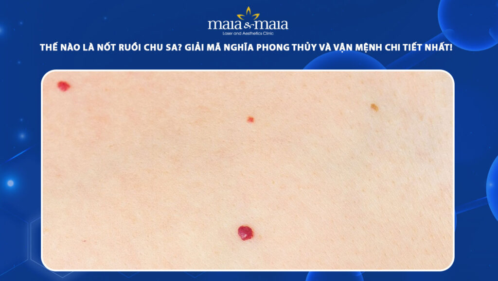 nốt ruồi chu sa
