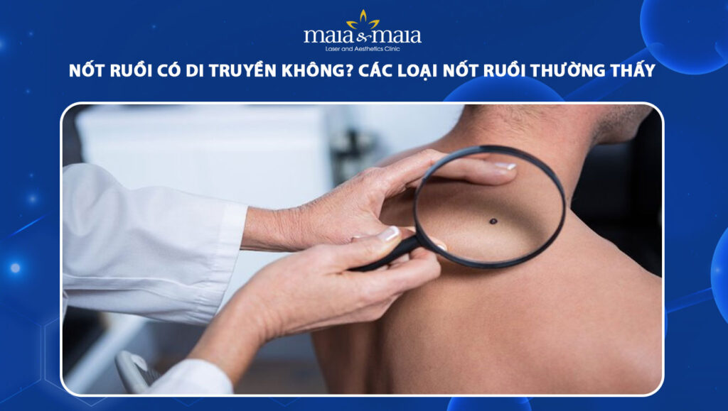 nốt ruồi có di truyền không