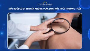 nốt ruồi có di truyền không